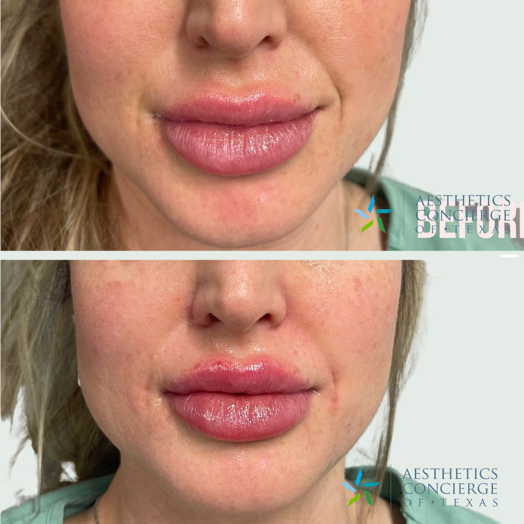 lip filler before and after